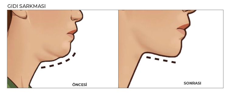 Gıdı sarkması öncesi ve sonrası