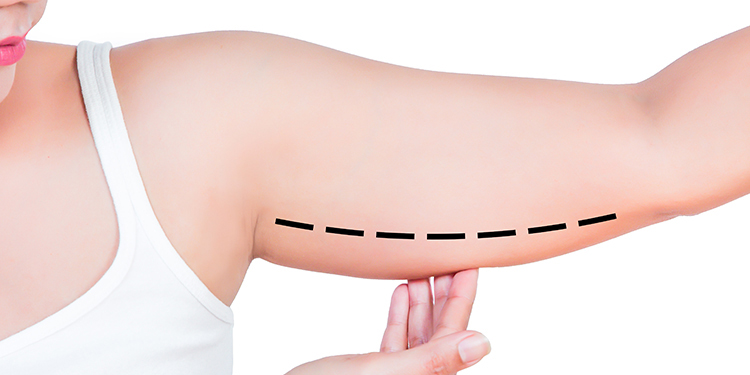 Arm Lift Surgery in Rochester, MN | Jacobson Plastic Surgery
