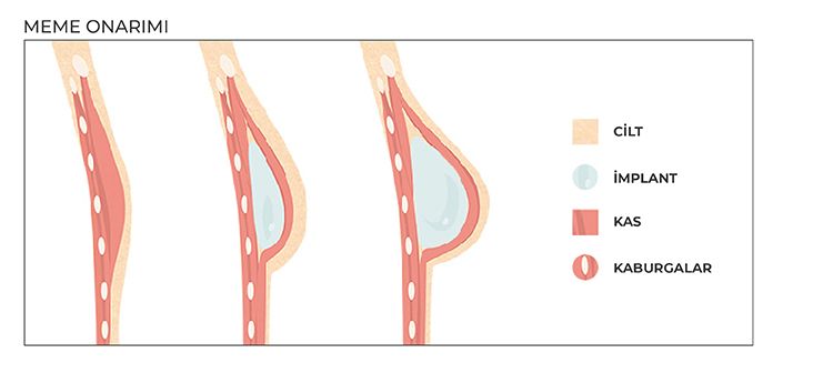 Meme onarımı öncesi ve sonrası illustrasyon