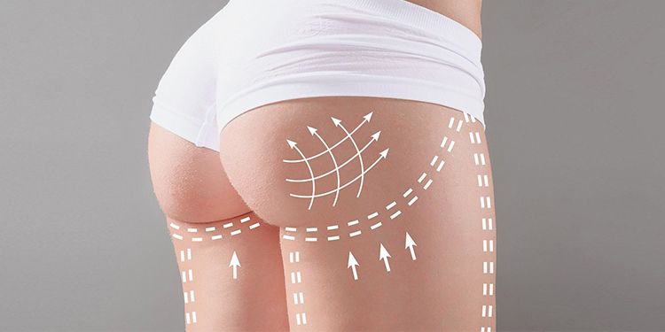 Buttock Lift Surgery (Buttock Aesthetic Surgery)