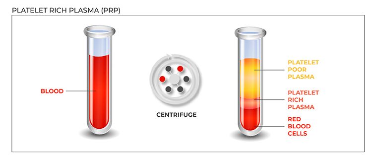 PRP illustration